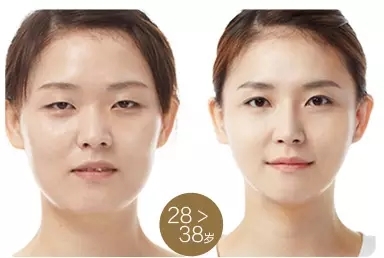 艺星艺星艺星美杜莎ECR重睑修复术