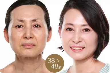 艺星艺星艺星美杜莎眼部紧致复眼术