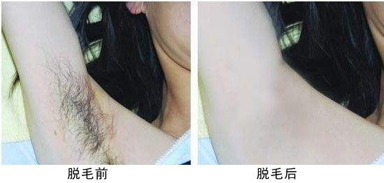 腋下脱毛