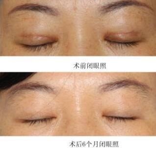 双眼皮失败可以修复吗？会不会疼？