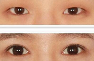 上睑下垂矫正术后怎样护理呢