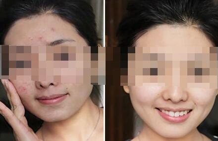 如何有效祛除青春痘