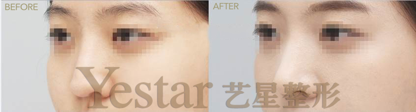 艺星艺星艺星美杜莎综合美眼前后对比图