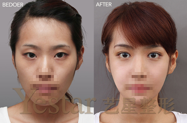 艺星艺星艺星美杜莎综合美眼前后对比图