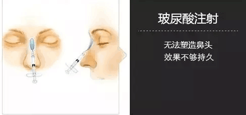北京隆鼻假体好还是好?