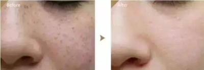 【雀斑治疗反馈图】