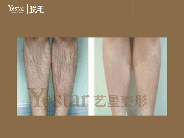 脱毛前后对比图