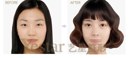 韩式三点双眼皮前后对比图