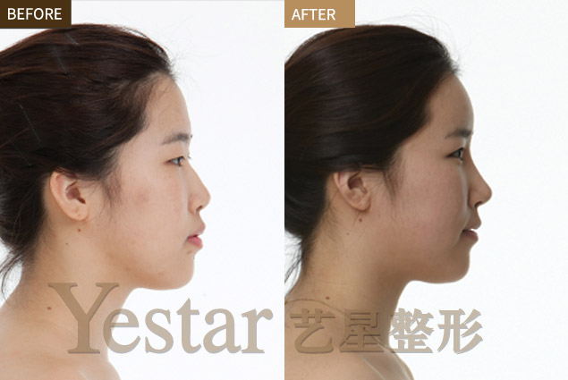 割双眼皮前后对比图