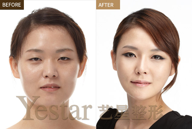 割双眼皮前后对比图