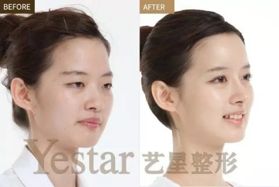 上睑下垂前后对比图