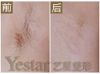脱毛前后对比图