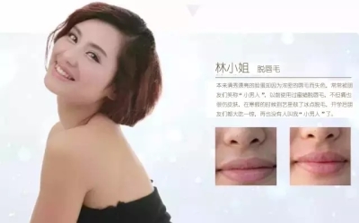 艺星脱毛真人案例