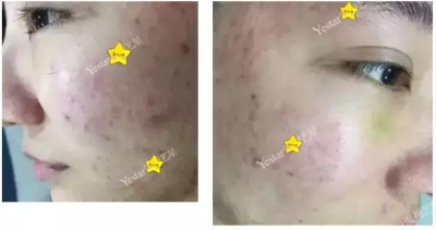 艺星祛痘真人案例
