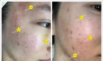 艺星祛痘真人案例