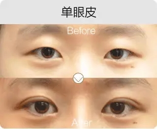 艺星艺星艺星艺星美杜莎综合美眼前后对比图