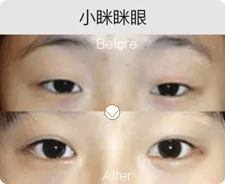 艺星艺星艺星艺星美杜莎综合美眼前后对比图