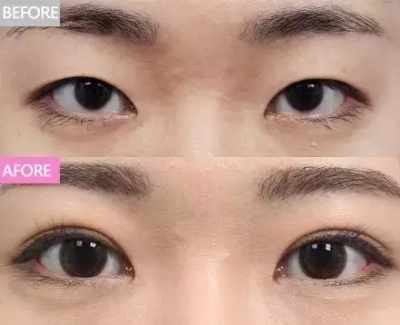 松弛 +上睑下垂