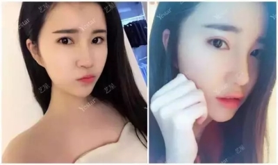 双眼皮前后对比图