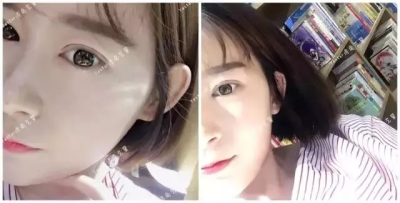 双眼皮前后对比图