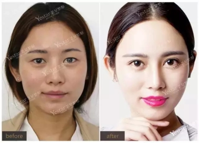 双眼皮前后对比图