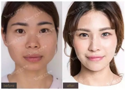 双眼皮前后对比图