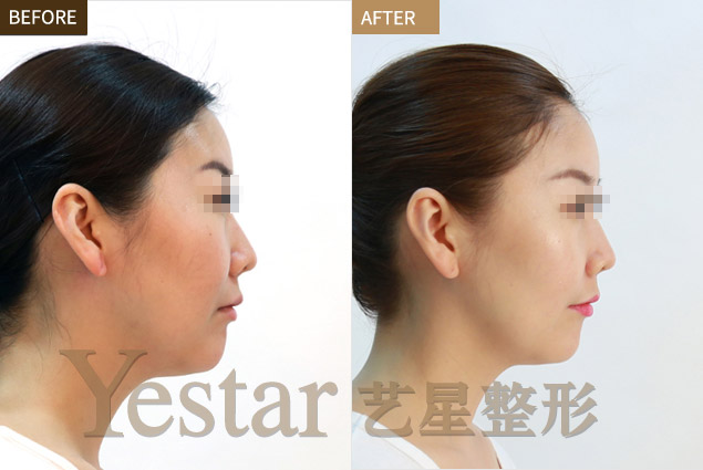 玻尿酸填充法令纹前后对比图