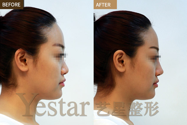 玻尿酸隆鼻前后对比图