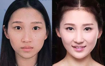 艺星割双眼皮前后对比图