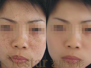 皮秒激光祛斑前后对比图