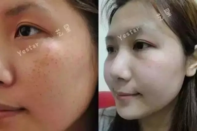 祛斑前后对比图