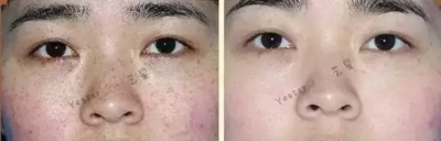 祛斑前后对比图