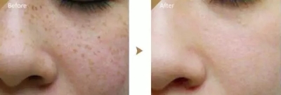 祛斑前后对比图