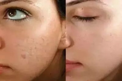 皮秒祛斑前后对比图