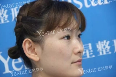 皮秒祛斑前后对比图