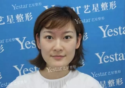 皮秒祛斑前后对比图