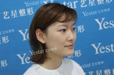 皮秒祛斑前后对比图