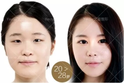 艺星艺星艺星美杜莎眼部年轻术