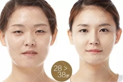 艺星艺星艺星美杜莎眼部重塑术