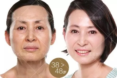 艺星艺星艺星美杜莎眼部重塑术