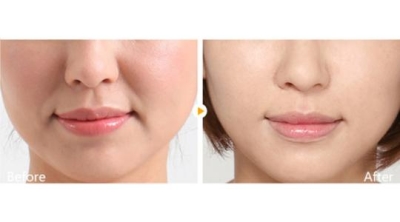 玻尿酸除皱,实现女性年轻梦想