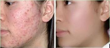 痘痘发生的原因有哪些?北京艺星为你讲解