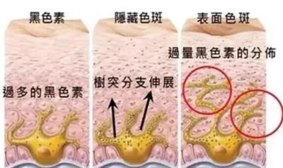 【北京艺星】色斑是如何形成的?你对色斑的了解有多少