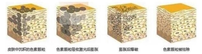 【北京艺星】色斑是如何形成的?你对色斑的了解有多少