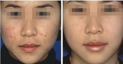 北京做激光祛痘多少钱