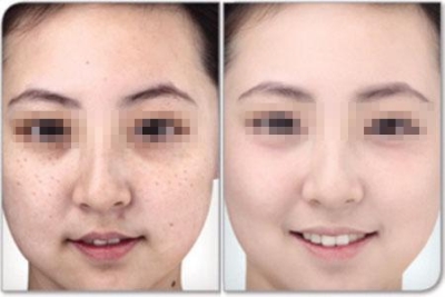 祛斑之后挥发女神气息!价格美丽