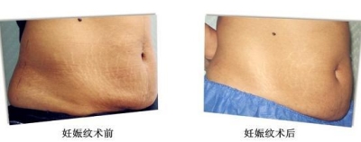 妊娠斑祛除,来北京艺星就对了