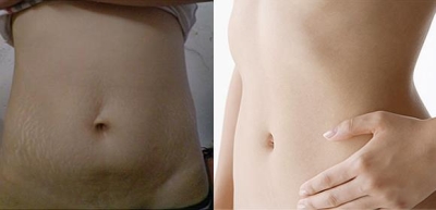 妊娠斑祛除,来北京艺星就对了