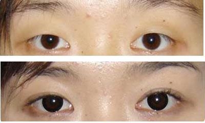 北京做上睑下垂矫正的高不高