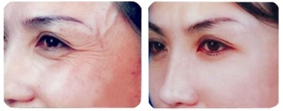 眼部去皱5大妙招,练就紧致双眸